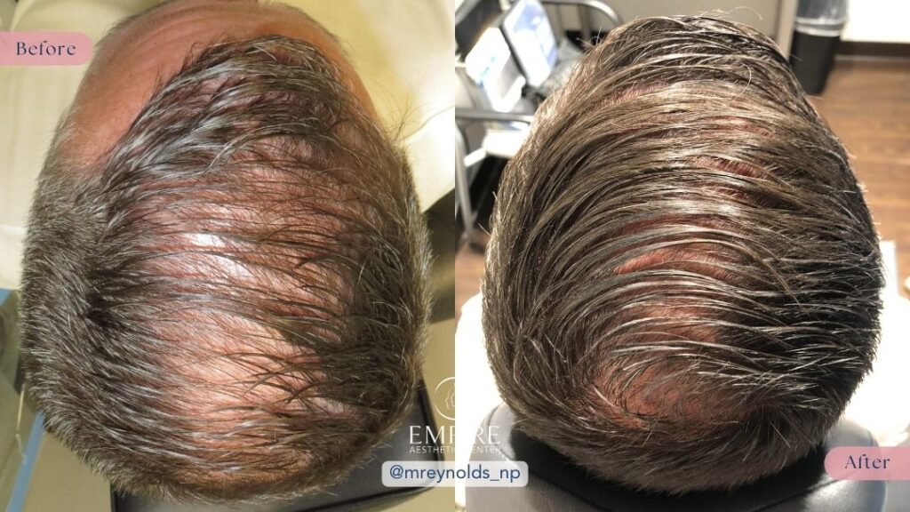 PRF Hair Regrowth Before and After in Bakersfield