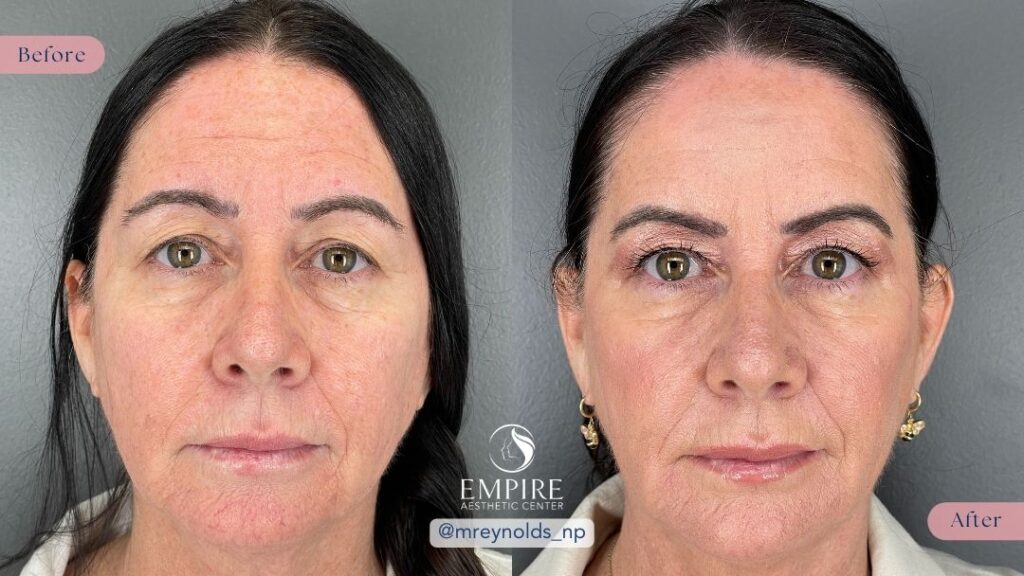 Dysport and Dermal Filler Before and After in Bakersfield