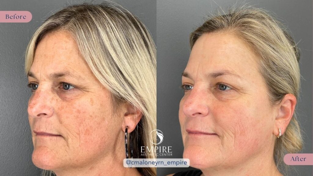 A photo showing the reduction in hyperpigmentation after treatment with BBL