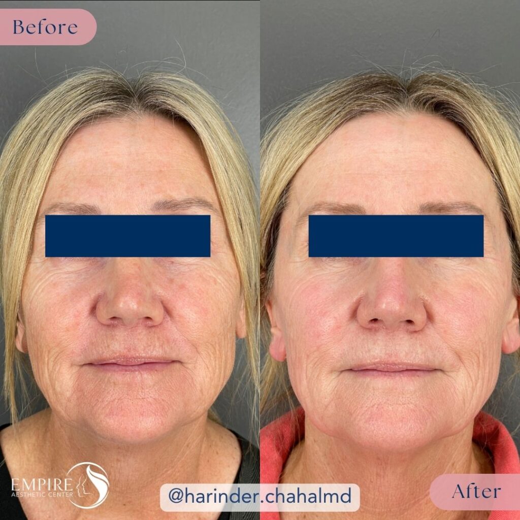 A before and after comparison showing the results of a Medical-Grade Chemical Peel in Bakersfield