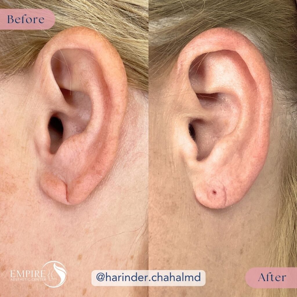 A before and after comparison showing the results of an Earlobe Repair surgery in Bakersfield