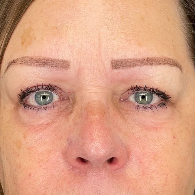 After Brow Pexy Surgery in Bakersfield