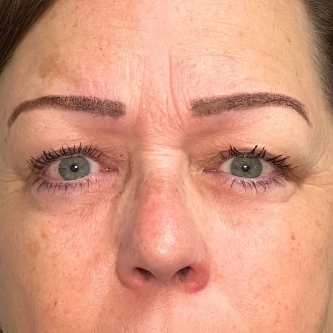 Before Brow Pexy Surgery in Bakersfield