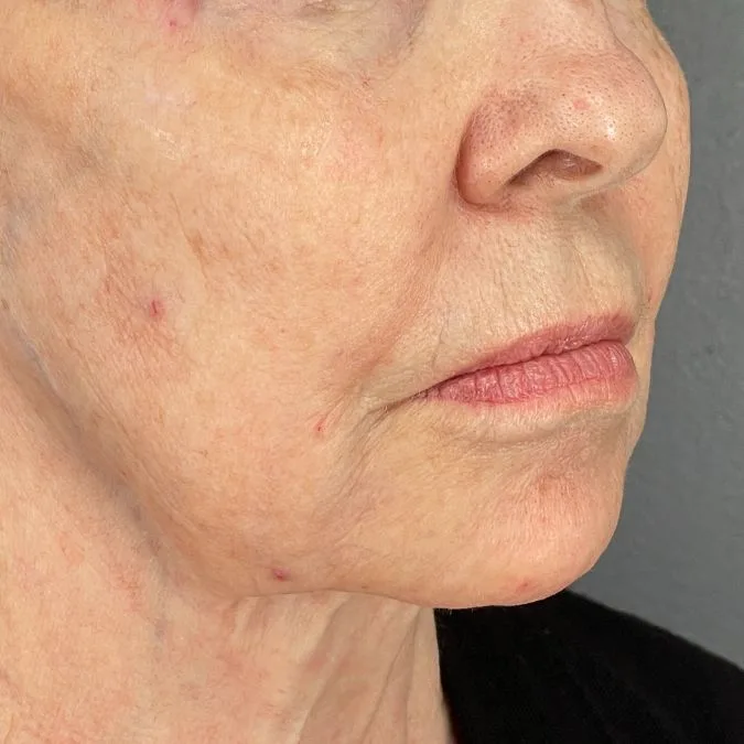 After Sofwave Lower Face Tightening