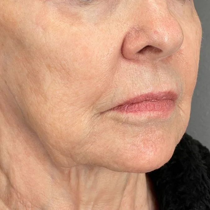 Before Sofwave Lower Face Tightening